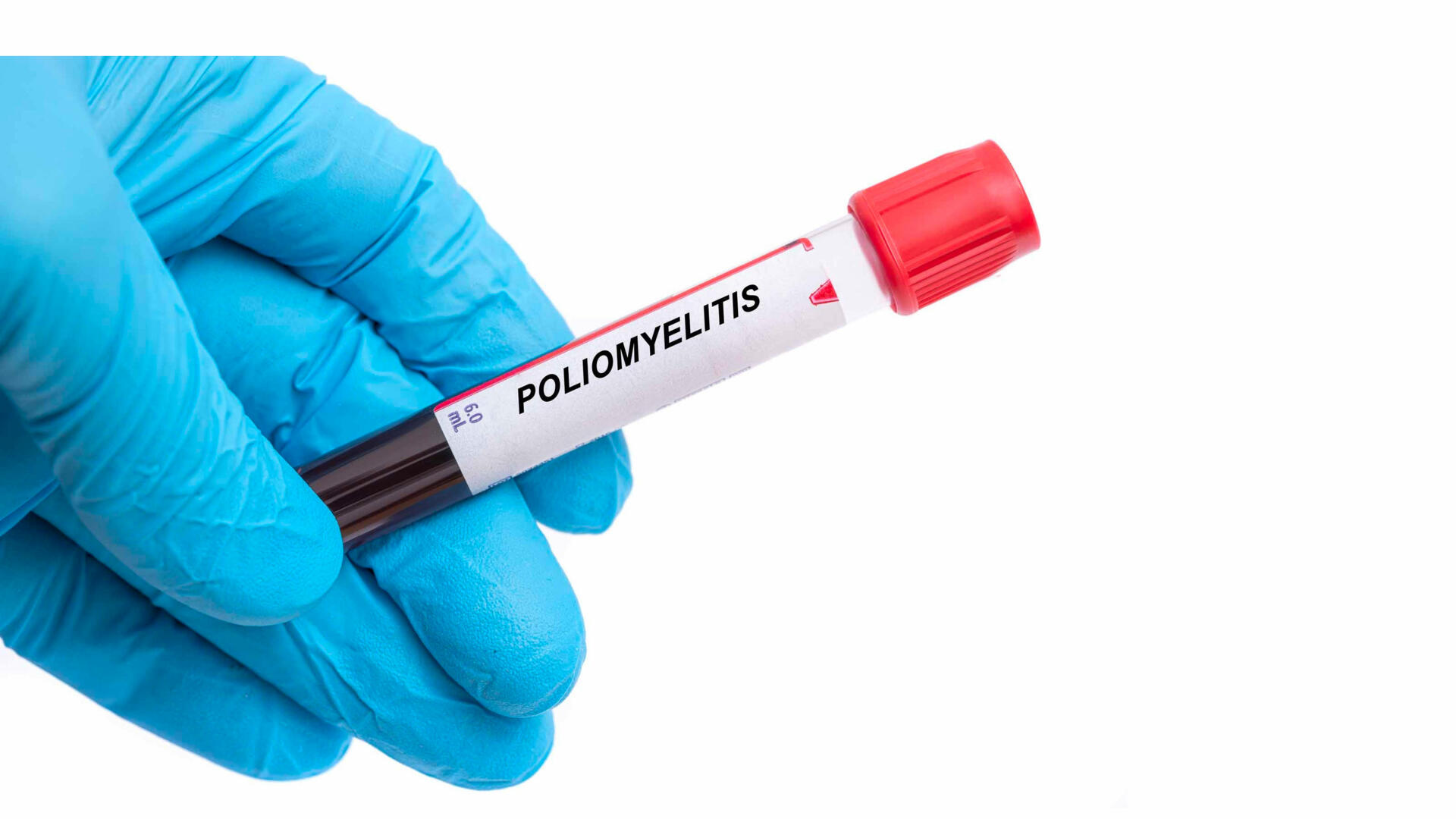 Poliomyélite : un cas confirmé dans la région Centrale, le ministère de la Santé active la riposte